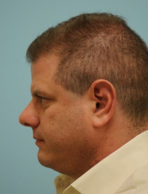 Rhinoplasty-Nose Job