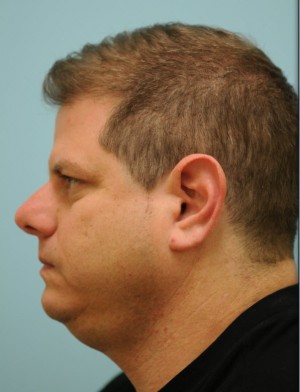 Rhinoplasty-Nose Job