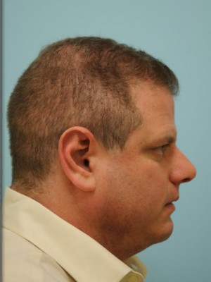Rhinoplasty-Nose Job