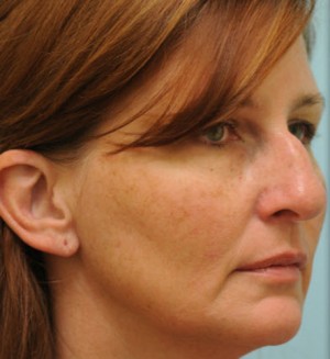 Rhinoplasty-Nose Job