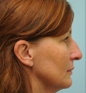 Rhinoplasty-Nose Job