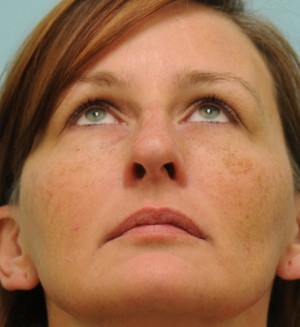 Rhinoplasty-Nose Job
