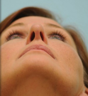 Rhinoplasty-Nose Job