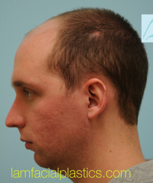 Chin Augmentation