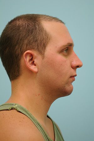 Chin Augmentation