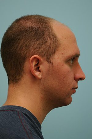 Chin Augmentation