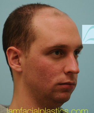 Chin Augmentation