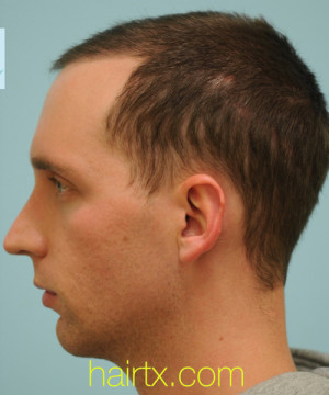 Chin Augmentation