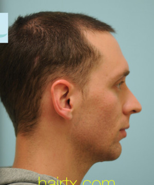 Chin Augmentation
