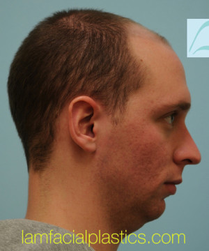 Chin Augmentation