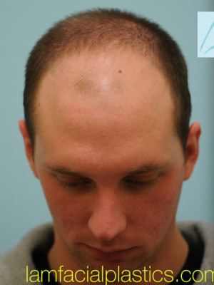 Chin Augmentation