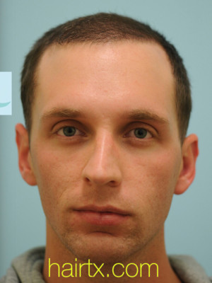 Chin Augmentation