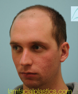 Chin Augmentation