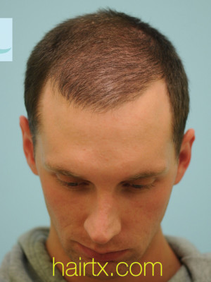 Chin Augmentation