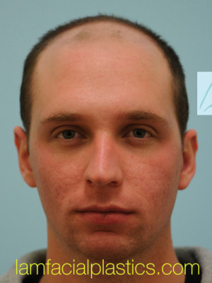 Chin Augmentation