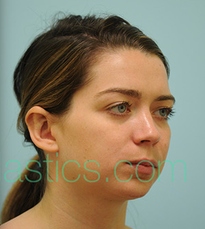 Otoplasty (Cosmetic Ear Reshaping)