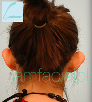 Otoplasty (Cosmetic Ear Reshaping)