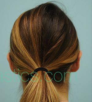 Otoplasty (Cosmetic Ear Reshaping)
