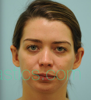 Otoplasty (Cosmetic Ear Reshaping)