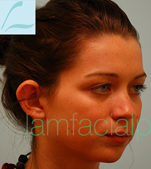 Otoplasty (Cosmetic Ear Reshaping)