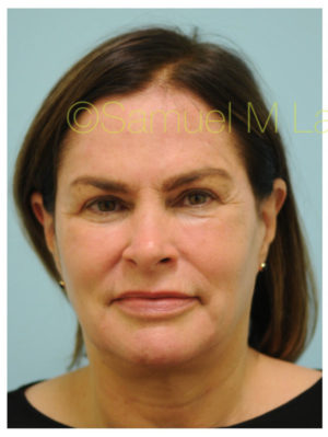 Primary Facial Fat Transfer