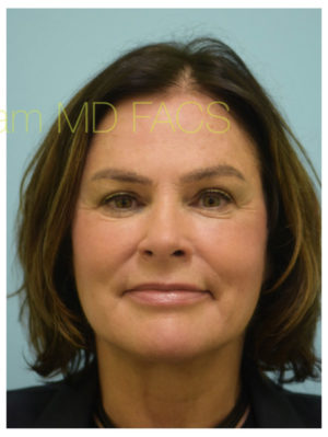 Primary Facial Fat Transfer