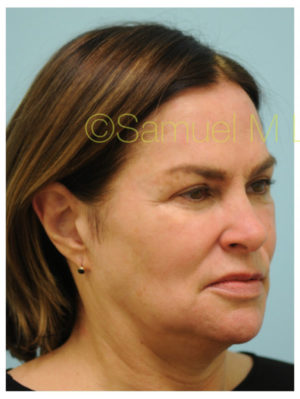 Primary Facial Fat Transfer