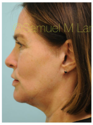 Primary Facial Fat Transfer
