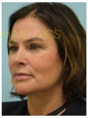 Primary Facial Fat Transfer