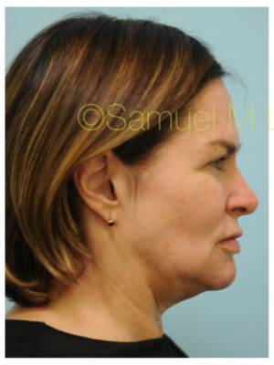 Primary Facial Fat Transfer