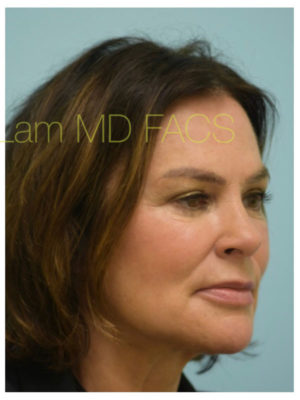 Primary Facial Fat Transfer