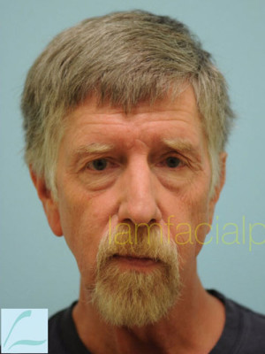 Chin Augmentation