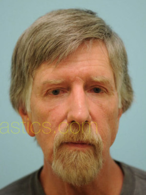 Chin Augmentation
