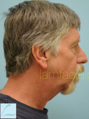 Chin Augmentation