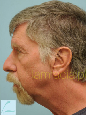Chin Augmentation