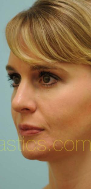 Rhinoplasty-Nose Job