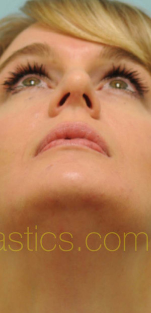 Rhinoplasty-Nose Job