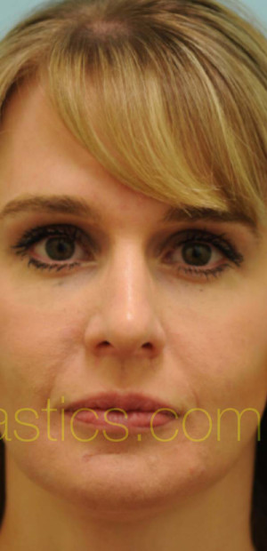 Rhinoplasty-Nose Job