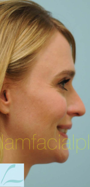 Rhinoplasty-Nose Job