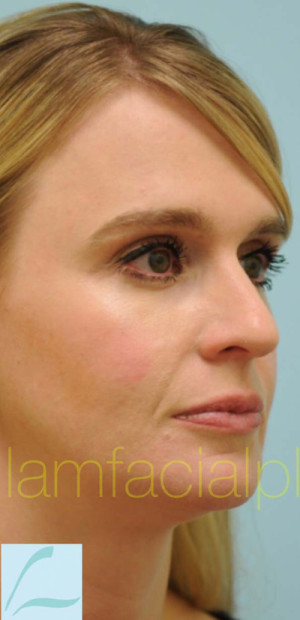 Rhinoplasty-Nose Job