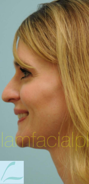 Rhinoplasty-Nose Job