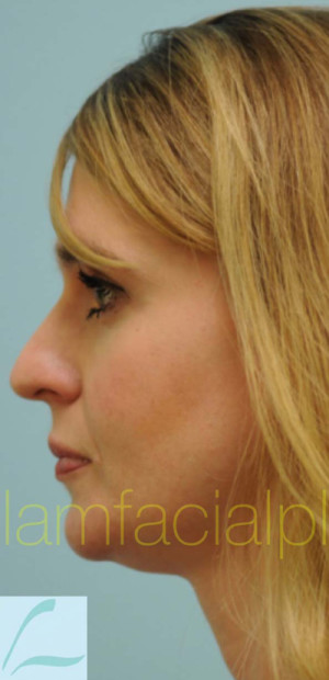 Rhinoplasty-Nose Job