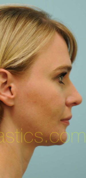 Rhinoplasty-Nose Job