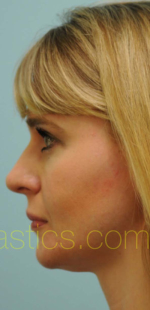 Rhinoplasty-Nose Job