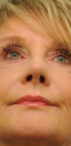 Revision/Corrective Rhinoplasty