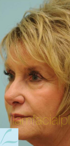 Revision/Corrective Rhinoplasty