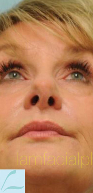 Revision/Corrective Rhinoplasty