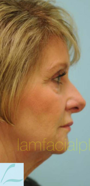 Revision/Corrective Rhinoplasty