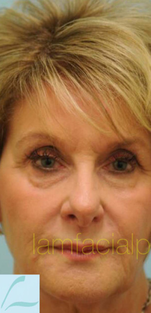 Revision/Corrective Rhinoplasty
