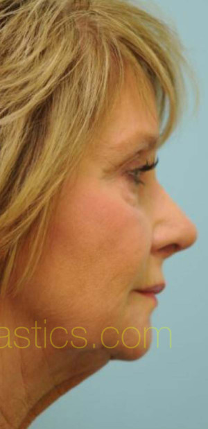 Revision/Corrective Rhinoplasty